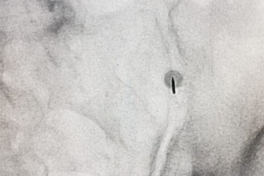 infiltrazione-epidurale-sacroilica-1u