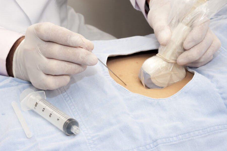 infiltrazione-epidurale-sacroilica-2