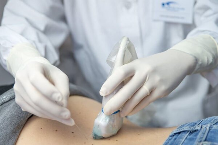 infiltrazione-perinervosa-1