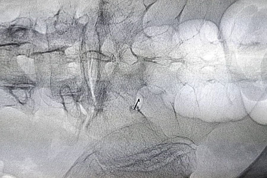 infiltrazioni-epidurale-5