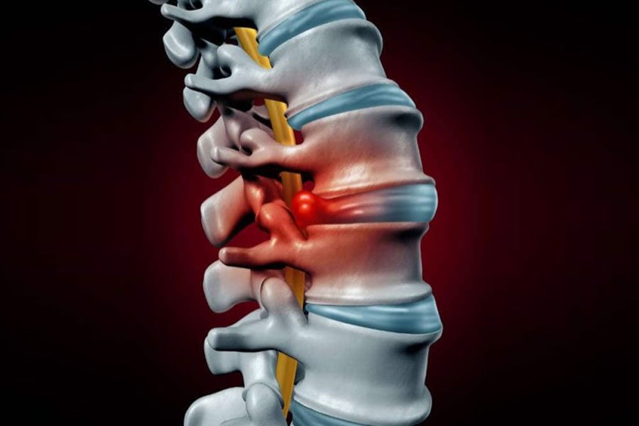 infiltrazioni-epidurale-6