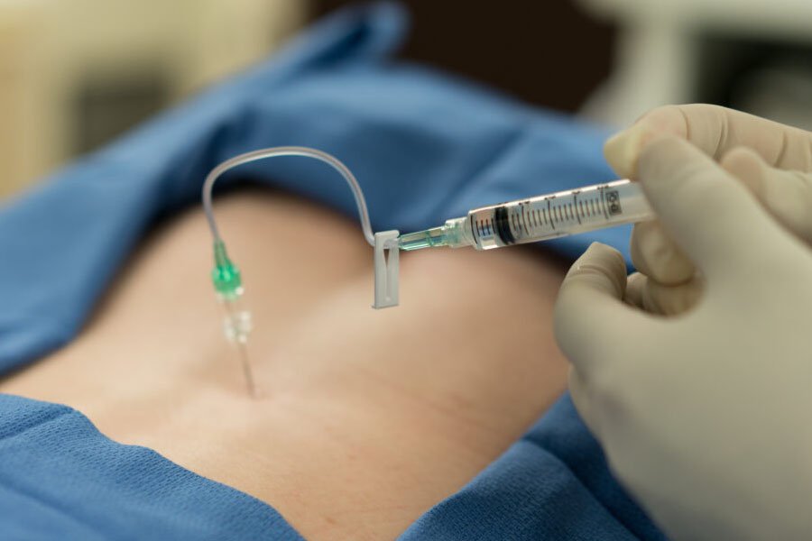 infiltrazioni-lo-bianco-epidurale