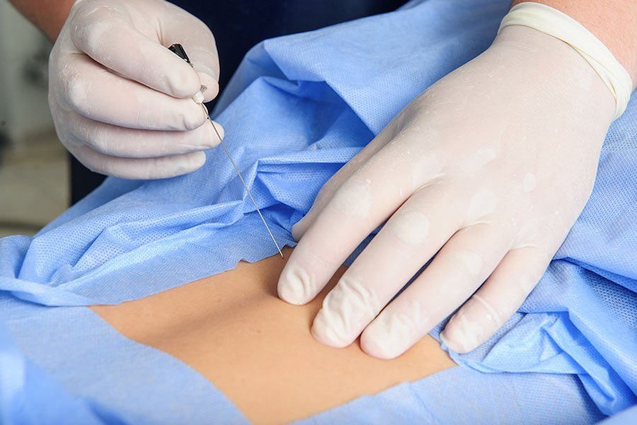 infiltrazioni-lo-bianco-faccette-articolarijpg