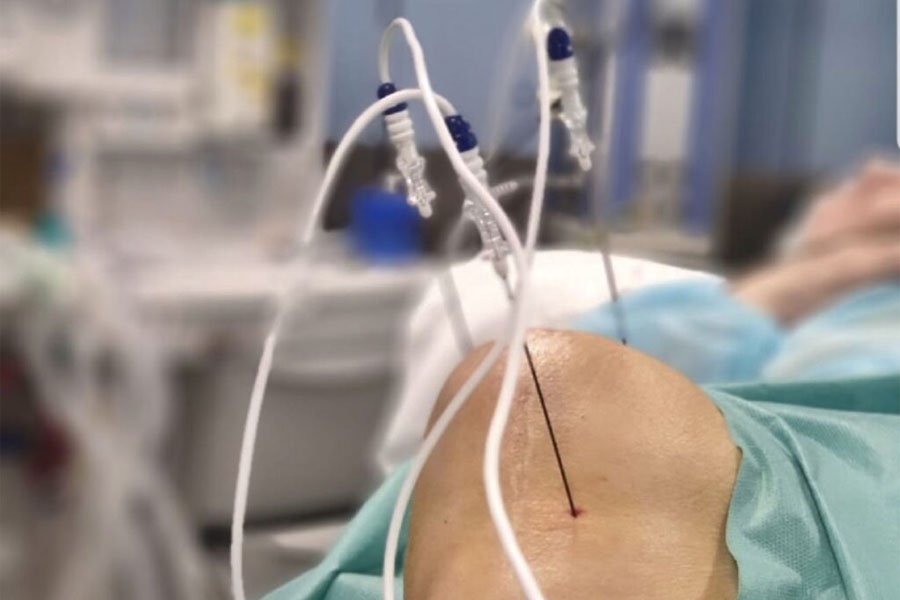 radiofrequenza-lo-bianco4