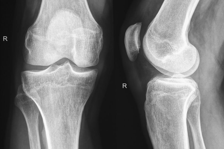 rx-ginocchio-lo-bianco-2