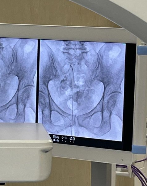 epidurolisi_0000_Livello-6