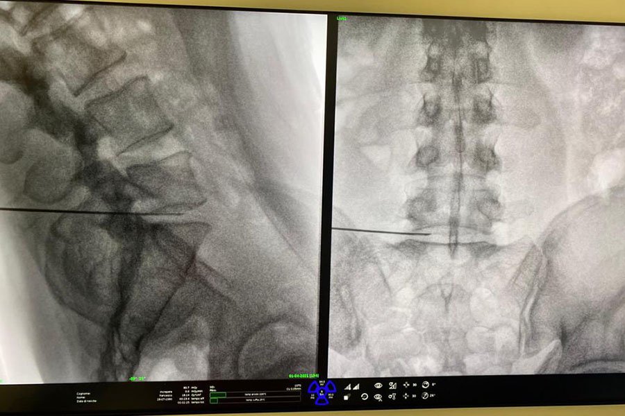 ossigeno-ozonoterapia-1