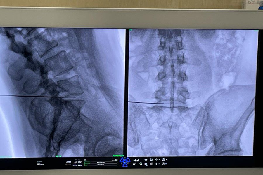 ossigeno-ozonoterapia-4