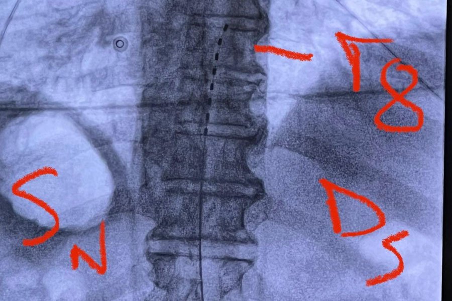 neuromodulazione-elettrica-4