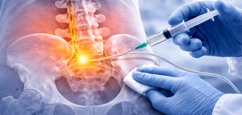 Infiltrazione epidurale per il dolore cronico